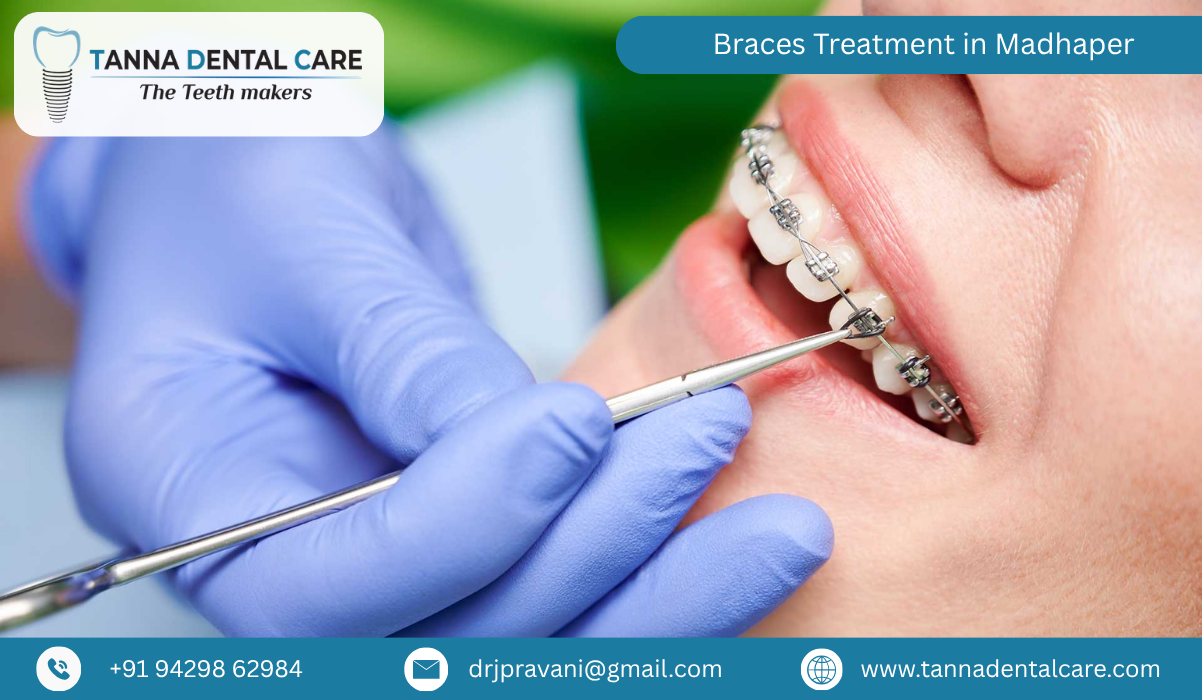 Braces Treatment in Madhaper