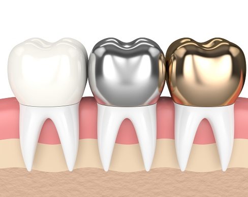 Crowns, Bridges & Veneers