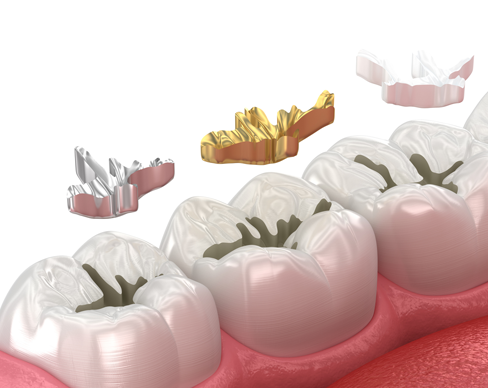 Dental Fillings