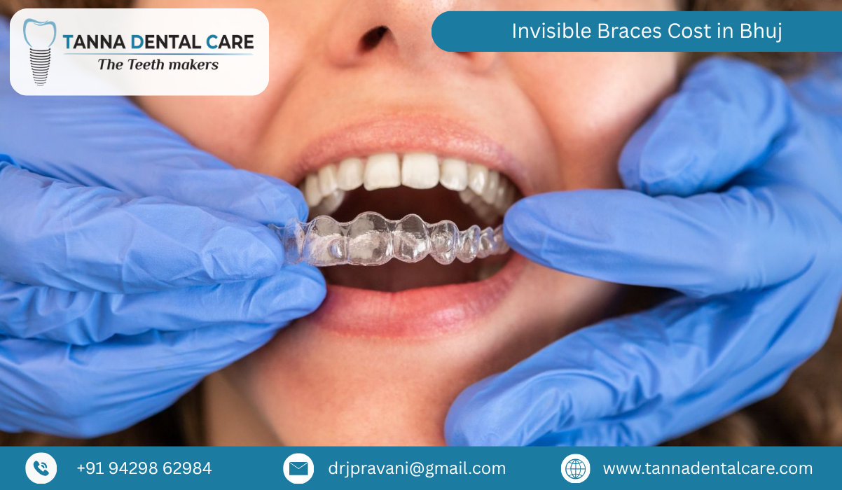 Invisible Braces Cost in Bhuj