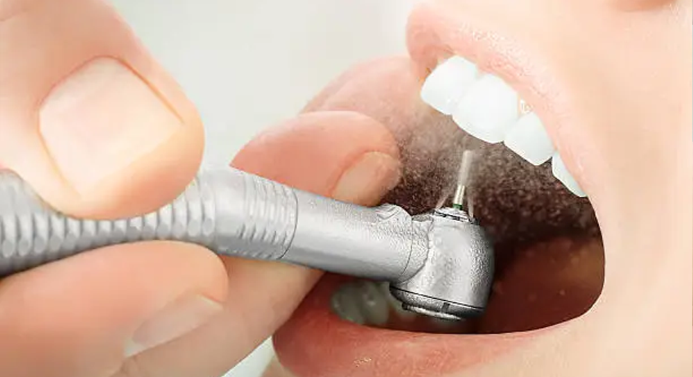 Restorative Dentistry Dental Filling