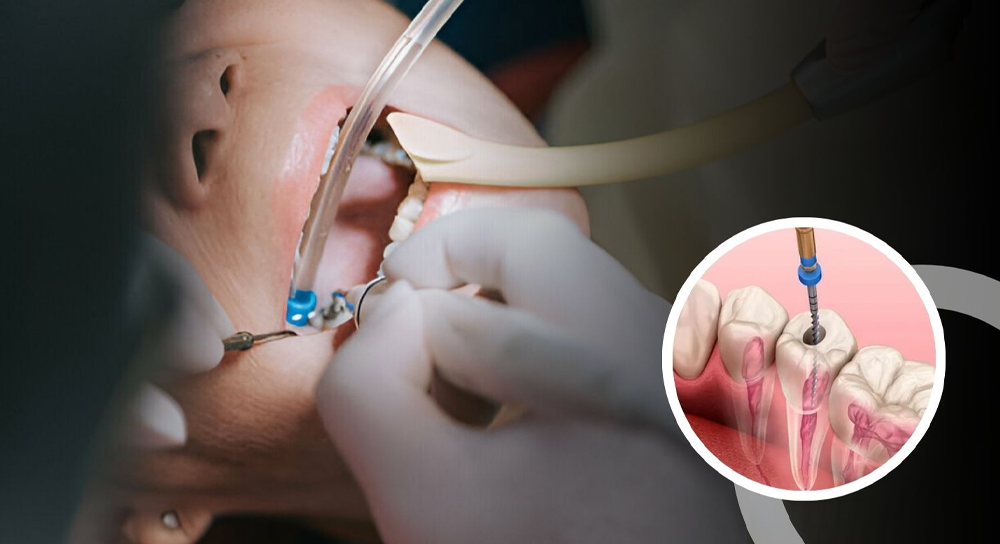 Root Canal Treatment