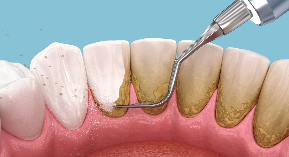 Root Canal Treatment