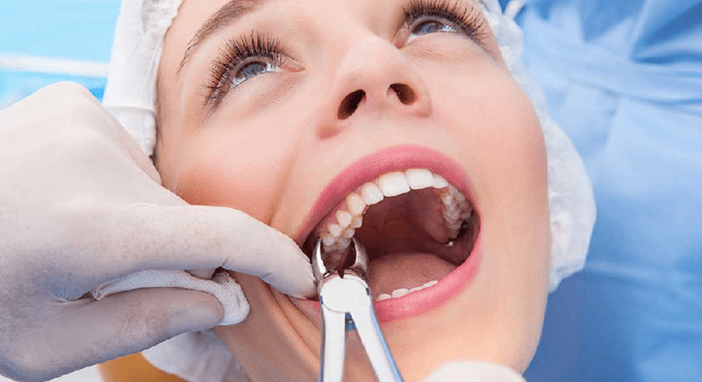 Extraction (Tooth removal)